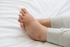 Отеки ног - Причины, симптомы, лечение и профилактика